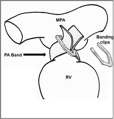 Pulmonary artery debanding in the cath lab: Lessons learned!